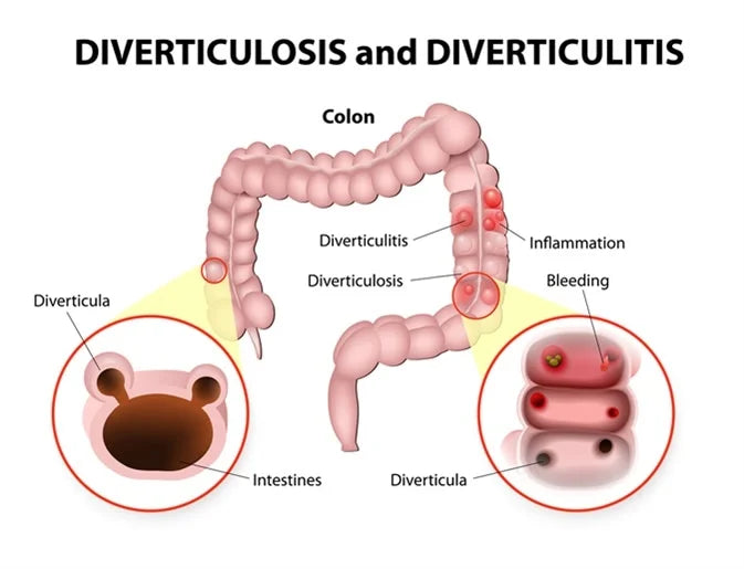 Navigating Diverticulitis | The Role of a Dietitian in Digestive Health