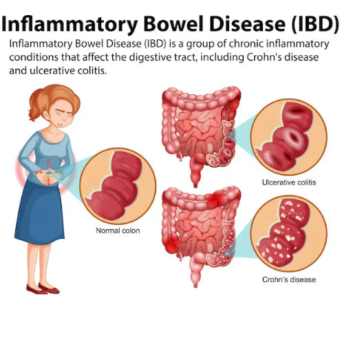 The Role of Dietitians in Managing Inflammatory Bowel Disease